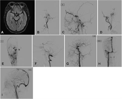 The combined transarterial and transvenous onyx embolization of dural arteriovenous fistula of hypoglossal canal via the external jugular vein and facial vein: A case report